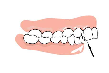 Gaps between teeth