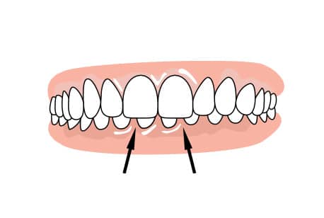 Metal braces to correct overbite