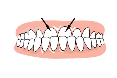 Braces to correct underbite