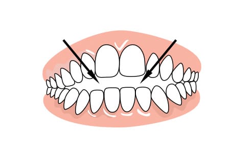 Braces to correct alignment of upper and lower teeth