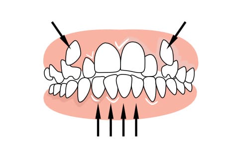 Braces to correct space between upper and lower teeth