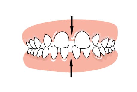 Braces to correct space between upper and lower teeth
