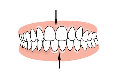 Braces to correct excessive crowding
