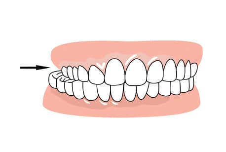 Braces to correct excessive crowding