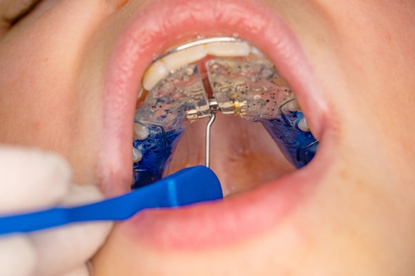 Palatal expanders on clay models