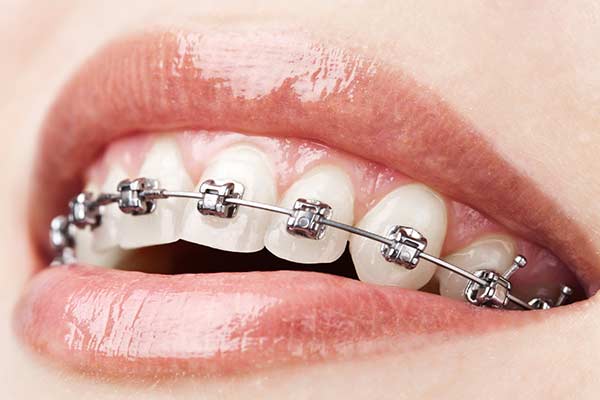 Self-ligating braces