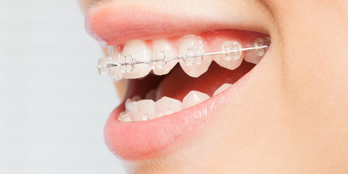 First days in braces decorative image