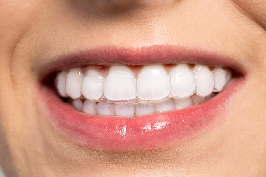 Pros and Cons of Using Clear Aligners to Straighten Your Teeth